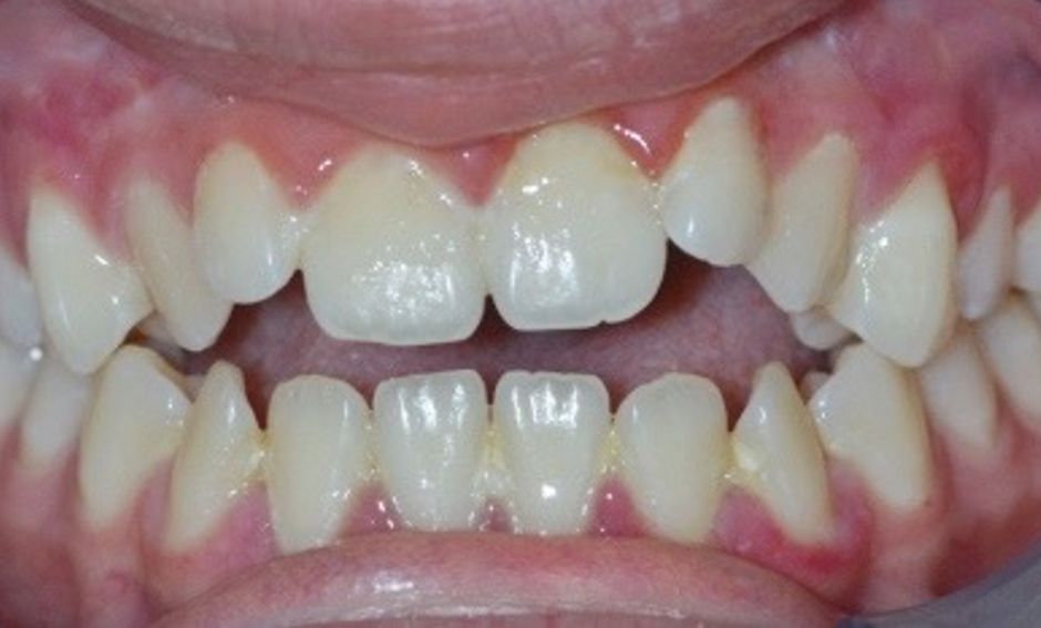 Ortodonzia su adulto