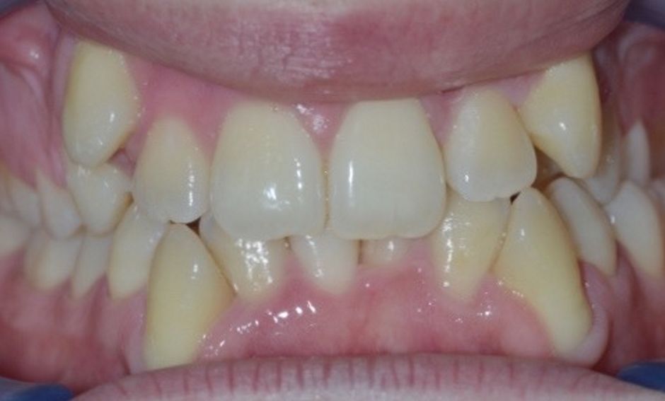 Ortodonzia estrattiva
